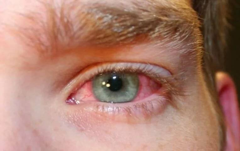 Красные глаза при простуде