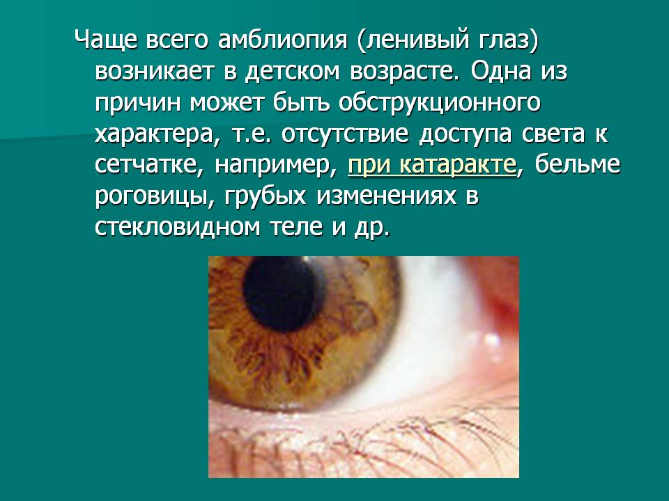Амблиопия у детей: что это такое, признаки и лечение при высокой степени, как лечить глаза в домашних условиях