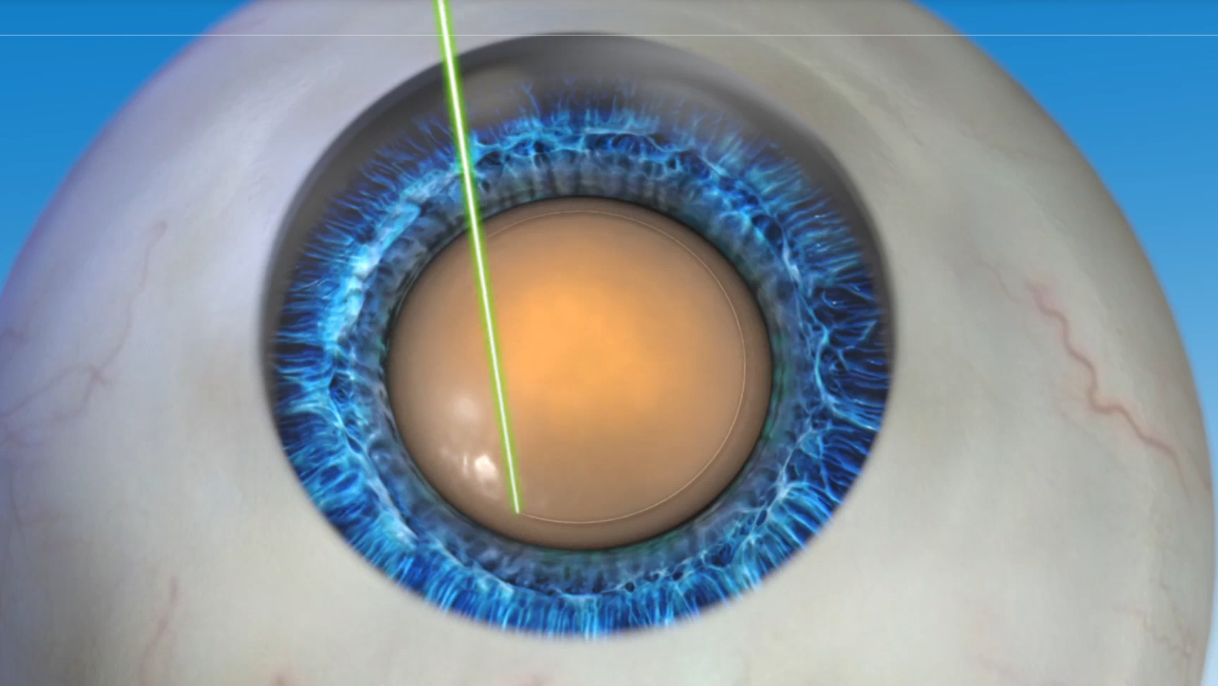 Вторичная катаракта: лечение лазером, кому можно чистить хрусталик, противопоказания для удаления