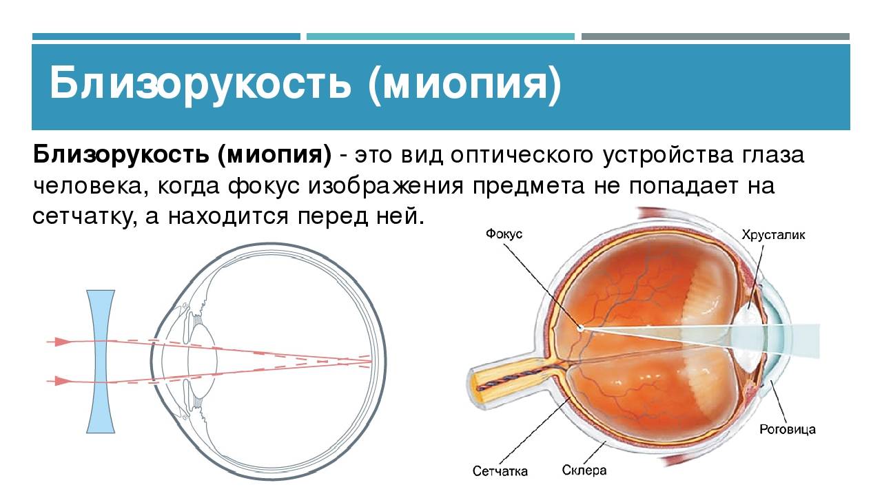 Миша страдает близорукостью а его брат дальнозоркостью. Заболевание органов зрения миопия. Строение глаза при миопии. Строение близорукого глаза. Изменение глазного яблока при близорукости.