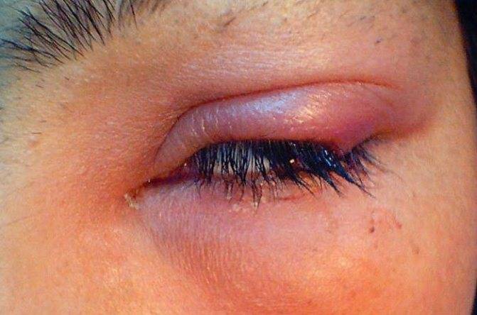 Герпес на веке глаза: симптомы и лечение заболевания