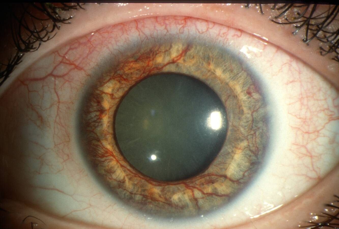 Какие существуют стадии глаукомы и чем они отличаются? — глаза эксперт