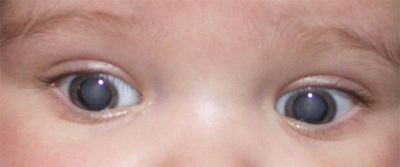 Причины возникновения врожденной катаракты у детей