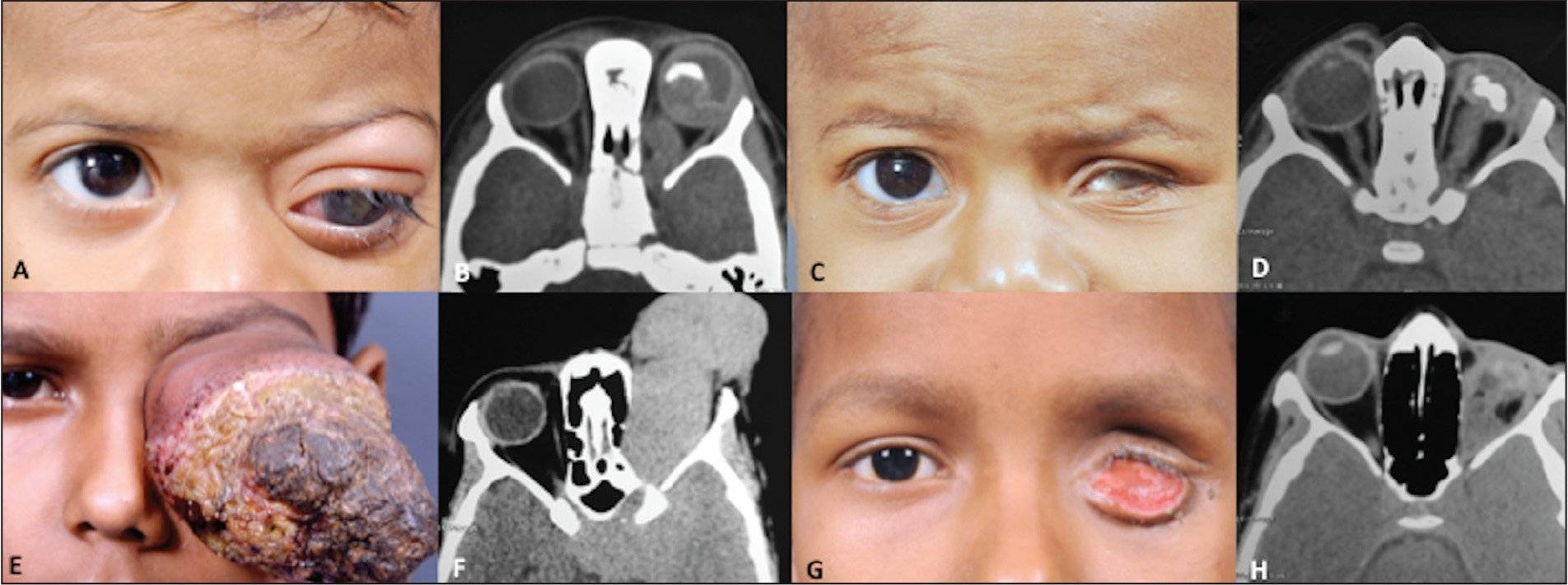 Ретинобластома глаз у детей: причины, симптомы, лечение, фото