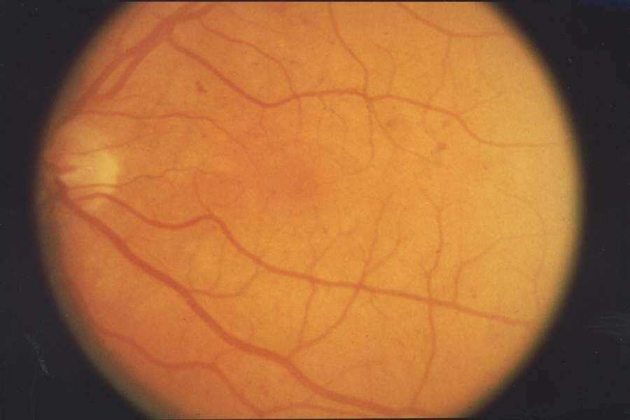 Фоновая ретинопатия и ретинальные сосудистые изменения у детей и взрослых