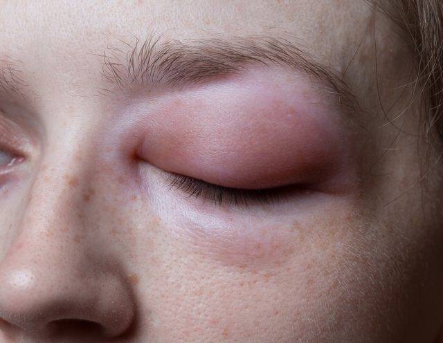 Как и чем снять отек с глаза в домашних условиях после удара, слез и аллергии?