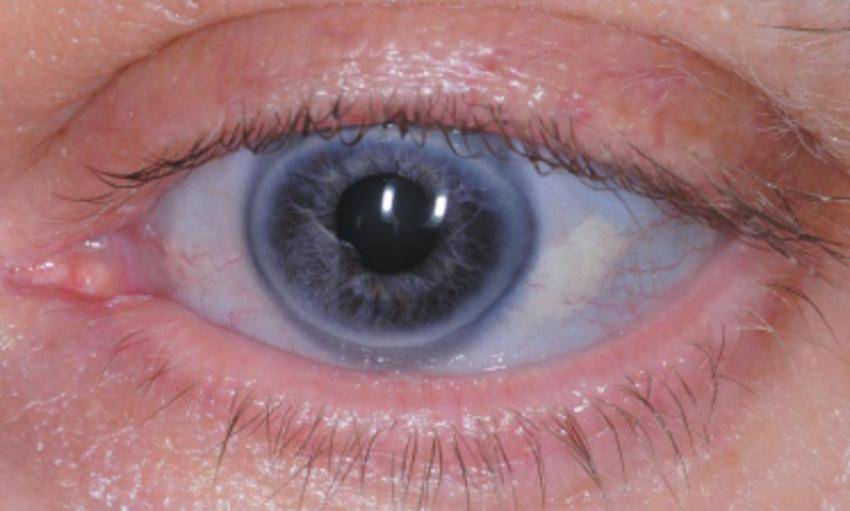 Голубые глаза у мужчин и женщин - "здоровое око"