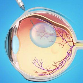Мне предстоит замена хрусталика глаза при катаракте. как пройдет послеоперационный период?