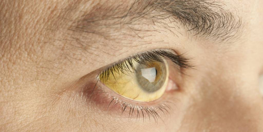 Почему желтеют белки глаз?
