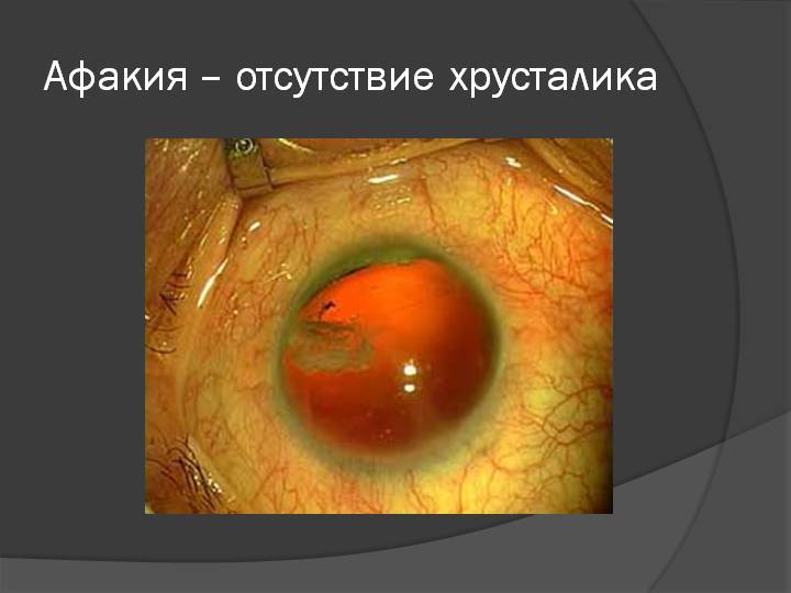 Афакия глаза: причины, симптомы, диагностика и лечение