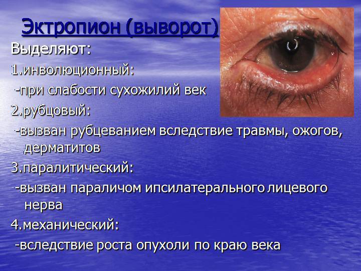 Выворот нижнего и верхнего века (эктропион глаза): исправление и лечение