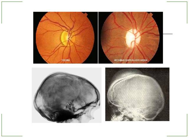 Неврит глазного нерва: симптомы и лечение воспаления зрительного нерва