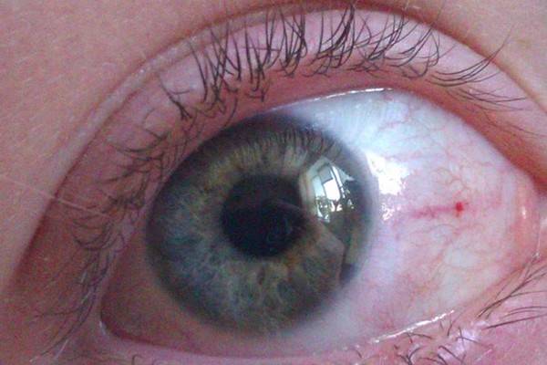 Жёлтые пятна на белке глаза