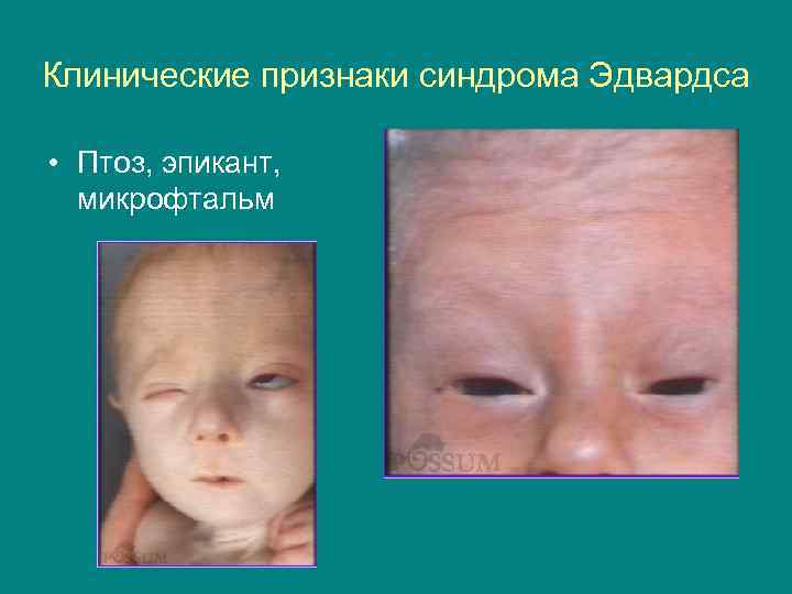 Микрофтальм - причины, симптомы и лечение. московская глазная клиника - опытные врачи, высокие результаты, доступные цены!