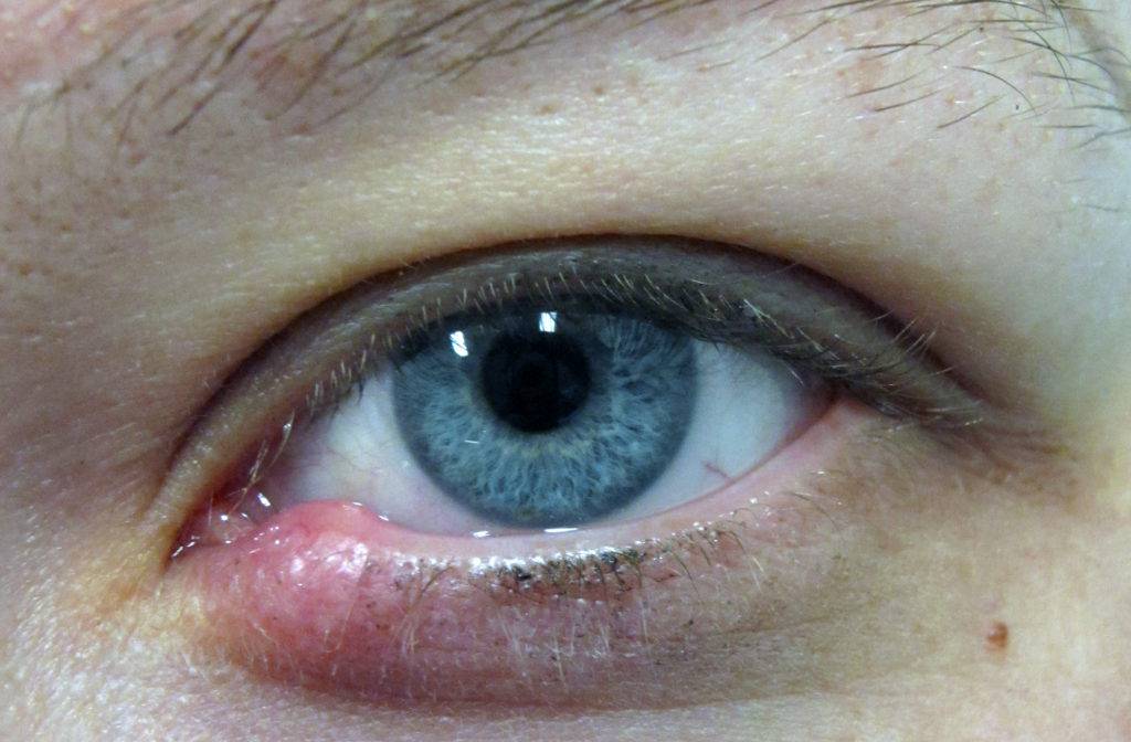 Болят веки глаз — почему болят веки? что делать если болят веки глаз?