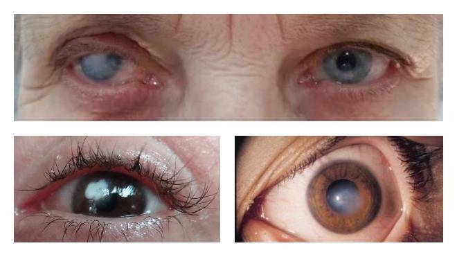Как вылечить помутнение роговицы глаза — советы офтальмолога