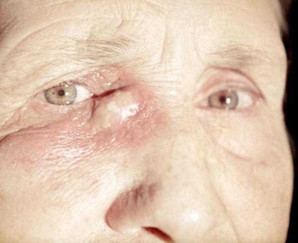 Рак глаз: первые симптомы при онкологии века