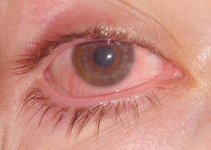 Ожог глаз кварцевой лампой: симптомы, первая помощь, лечение.