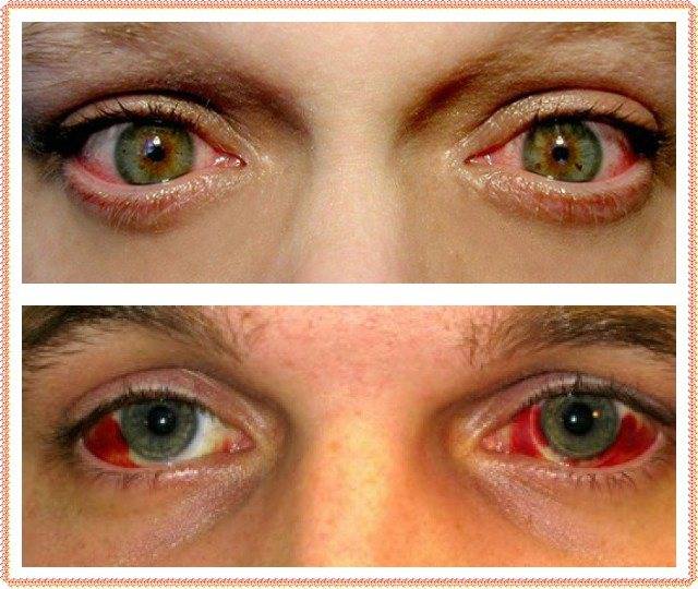 Кровоизлияние в глаз: причины и лечение, какие капли капать, диагностика, локализация (в склере, сетчатке, белке, передней камере), фото, профилактика