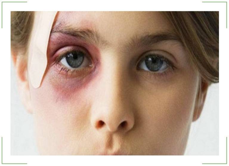 Синяк под глазом от удара через сколько дней проходит после ушиба над глазницей, как долго по времени у ребенка не сходит отек