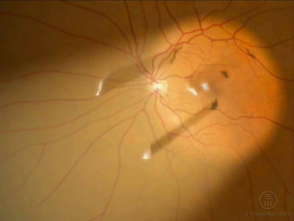 Стекловидное тело глаза: болезни, причины, симптомы и лечение деструкции