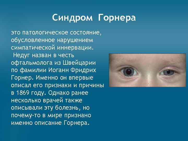 Синдром бернара горнера: лечение, причины и симптомы (фото)