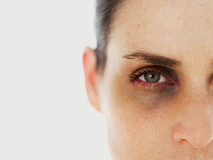 Темные круги под глазами: причины у женщин и мужчин, как избавиться