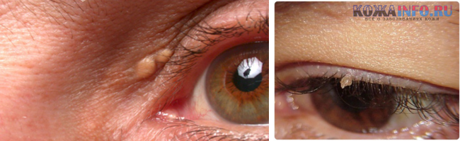 Папиллома на веке глаза: фото, симптомы, удаление и лечение