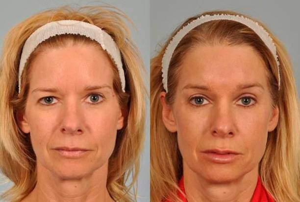 Асимметрия лица: причины и лечение у взрослых | исправить несимметричное лицо без операций в клинике орто-артель