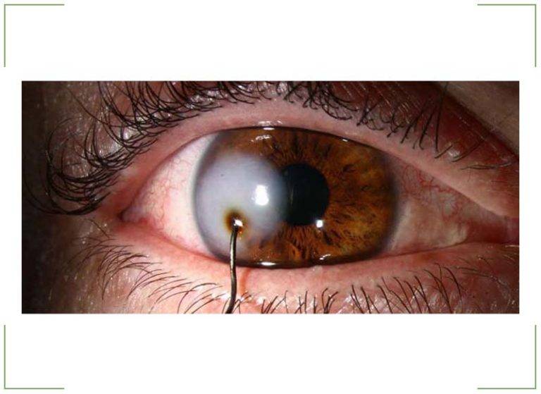 Боль в глазу при надавливании: причины, лечение - "здоровое око"