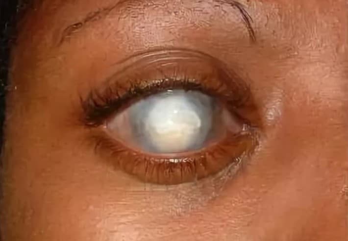 Бельмо на глазу – лейкомы глаза — офтальмология