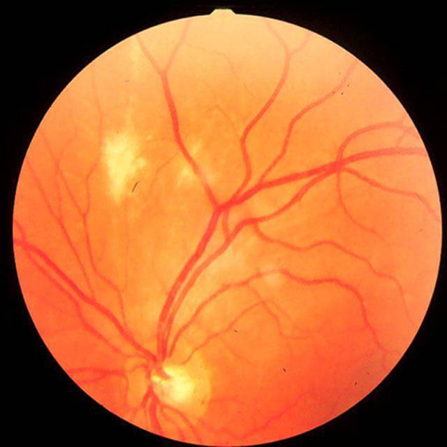 Ретинопатия сетчатки глаза: что это такое, симптомы и лечение
