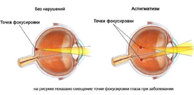 С каким зрением можно делать лазерную коррекцию зрения: показания при минусе и для плюсового видения, случаи, когда лкз нельзя
