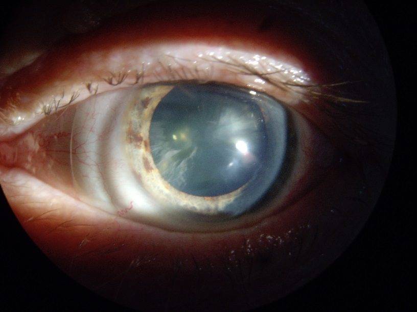 Помутнение задней капсулы хрусталика глаза: причины и лечение (лазерная дисцизия) - moscoweyes.ru - сайт офтальмологического центра "мгк-диагностик"
