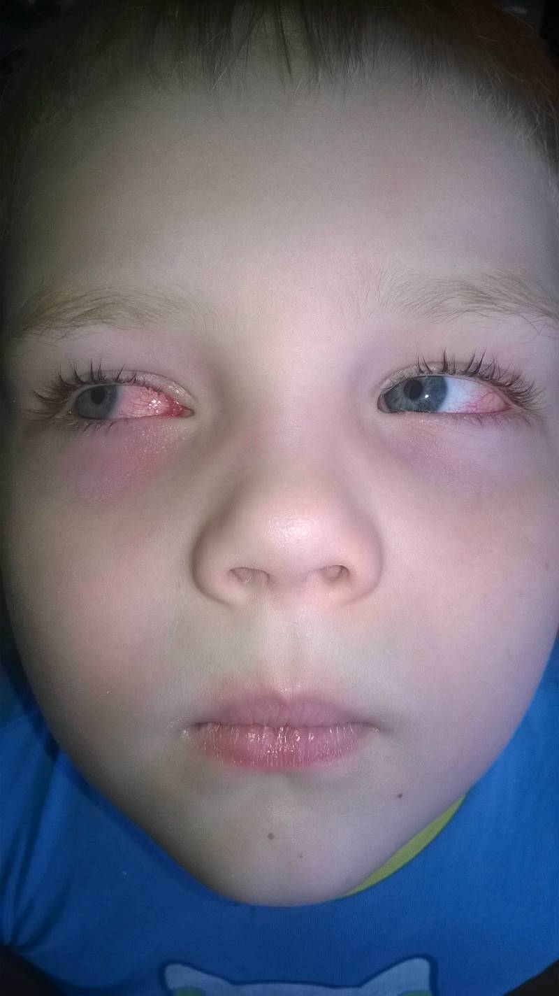 Красные глаза при простуде: основные симптомы - умный врач