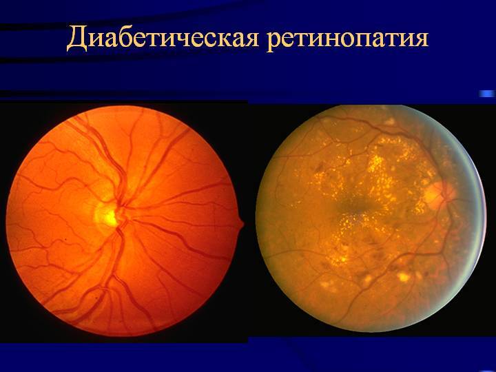 Диабетическая ретинопатия: медикаментозное лечение пролиферативной, непролиферативной ретинопатии каплями, уколами, препаратами, народными средствами, операцией, лазером