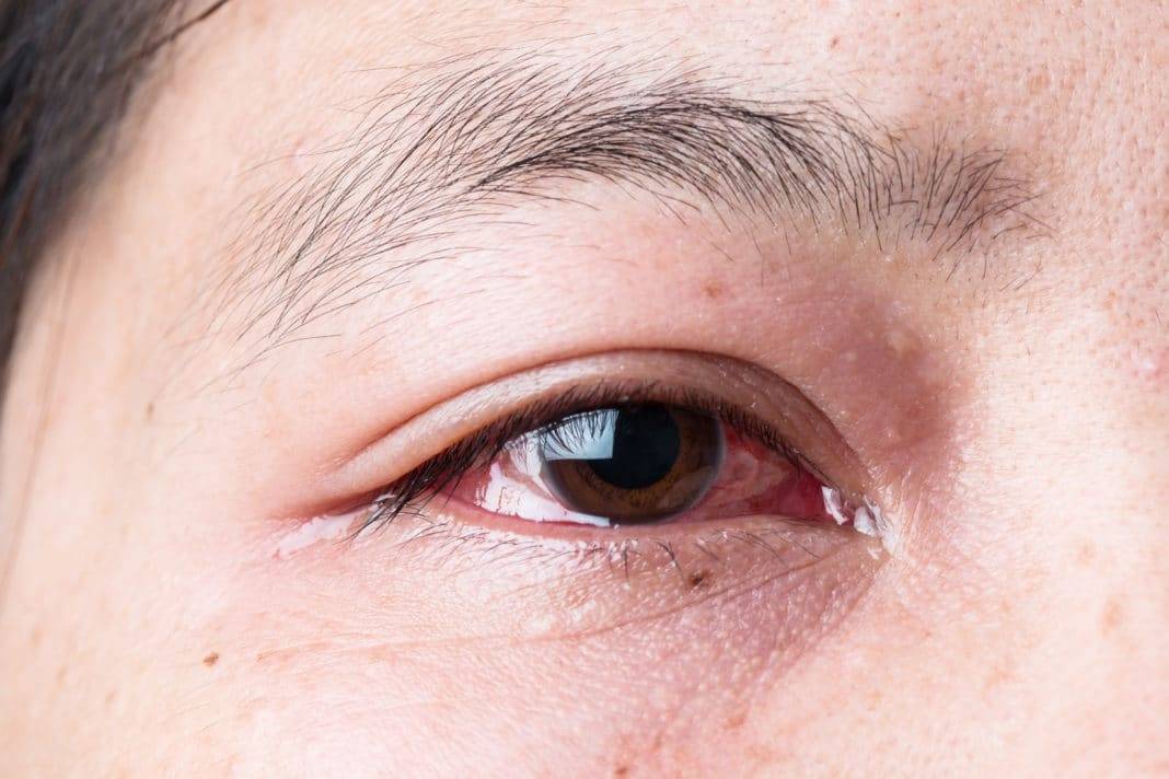 Веки красные: причины и лечение покраснения вокруг глаз, внутри у взрослого и ребенка, мази от гиперемии, сопутствующие симптомы (зуд, припухлость, жжение)