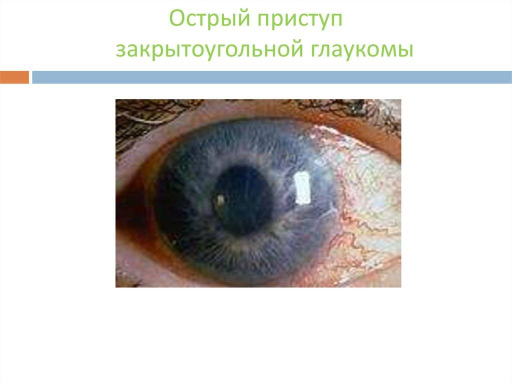 Первая помощь для глаз при глаукоме: как помочь больному правильно?