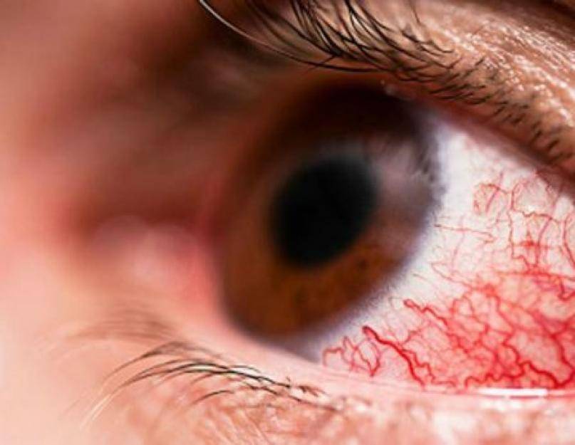Все возможные причины красных глаз после сна