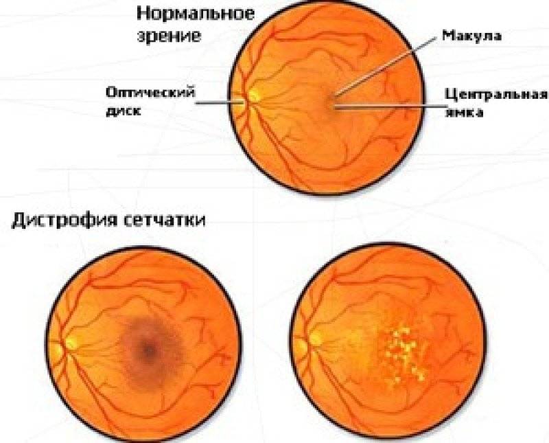 Дистрофия сетчатки глаза: симптомы, причины, лечение и профилактика