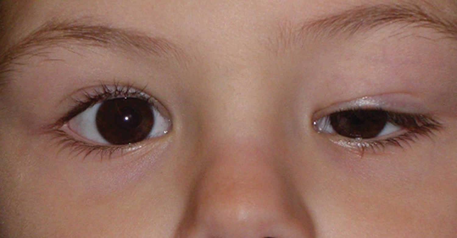 Болят веки глаз — почему болят веки? что делать если болят веки глаз?