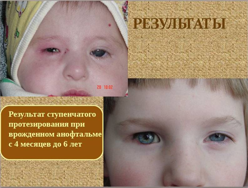 Микрофтальм: нарушение зрения у взрослых и детей, размеры глазного яблока, степени, виды, лечение дефекта