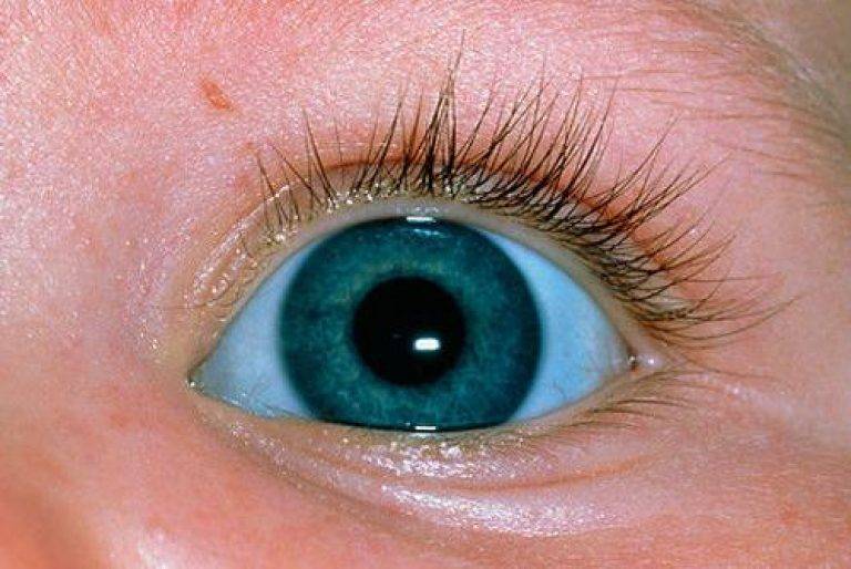 Белки глаз желтые: причины и как лечить, профилактика