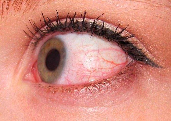 Прозрачный пузырек на глазу (на веке глаза): причины, возможные болезни, лечения - "здоровое око"