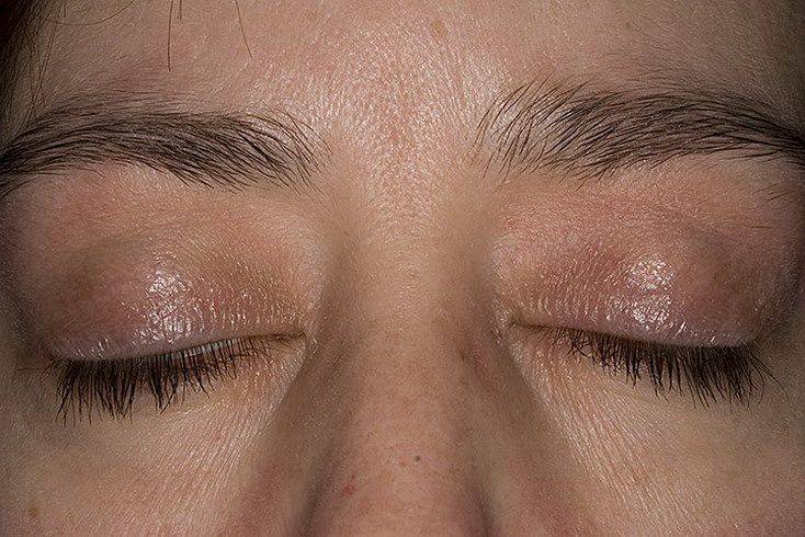 Методы лечения и причины возникновения дерматита вокруг глаз
