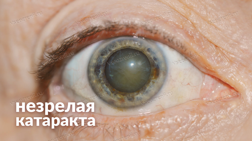 Начальная стадия катаракты: что делать и как остановить развитие