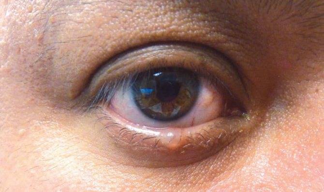 Киста на веке глаза: причины, симптомы и методы лечения - "здоровое око"