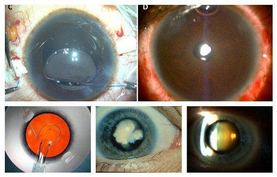 Классификация катаракты и характеристика основных типов