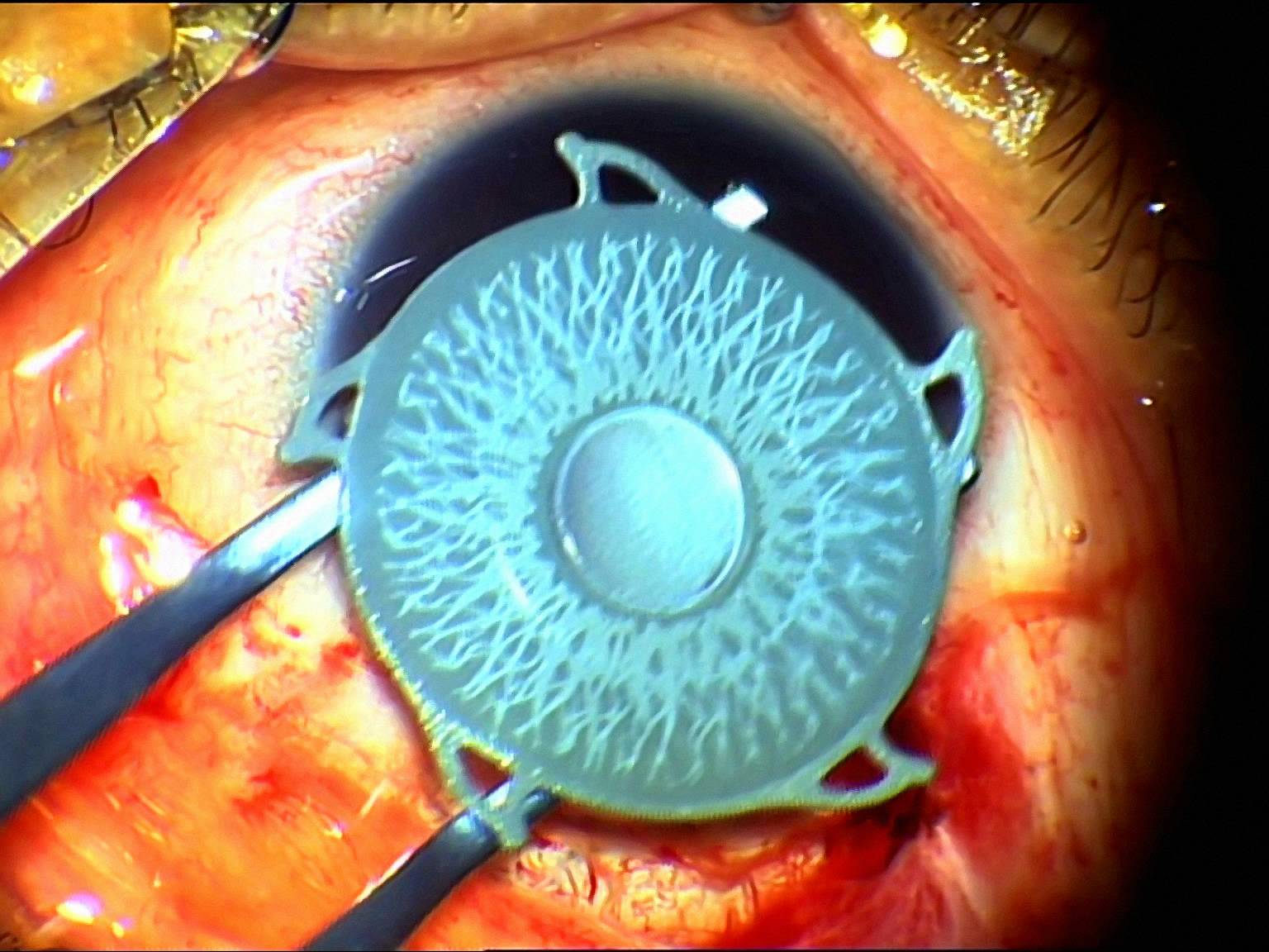 Какие есть показания к хирургическому лечению глаукомы: варианты операций и возможные последствия