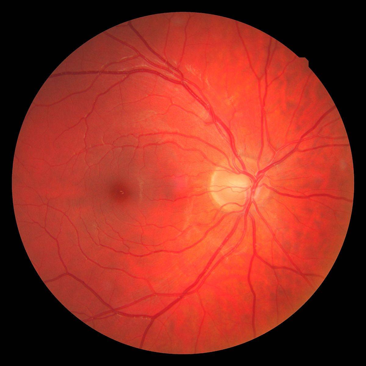 Скотома глаза: строение, симптомы, диагностика, лечение